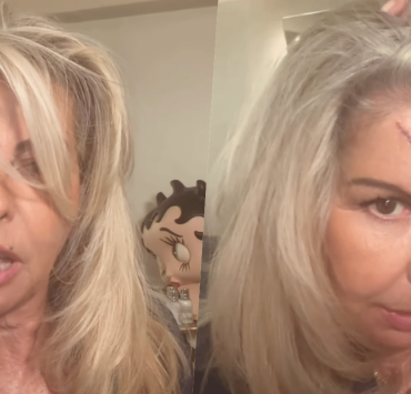 Affaire conclue : Caroline Margeridon fait une lourde chut sur un escalier et se retrouve avec une énorme entaille au visage
