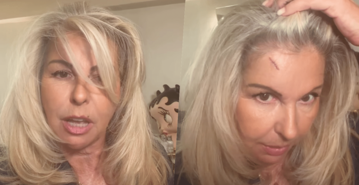 Affaire conclue : Caroline Margeridon fait une lourde chut sur un escalier et se retrouve avec une énorme entaille au visage