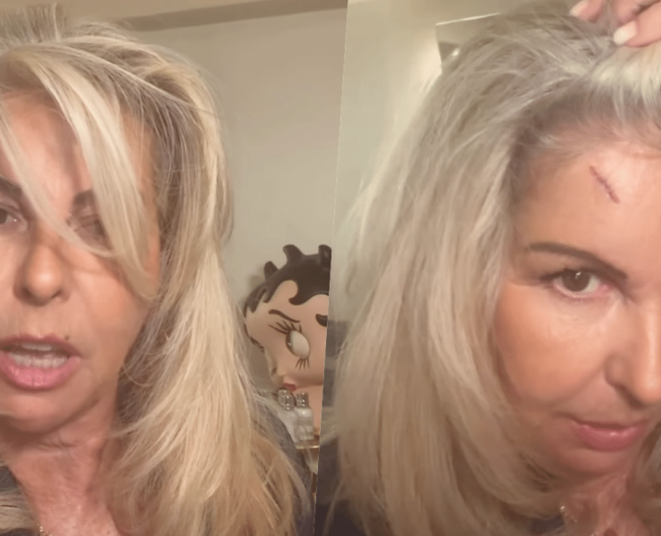 Affaire conclue : Caroline Margeridon fait une lourde chut sur un escalier et se retrouve avec une énorme entaille au visage